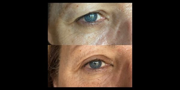 Before and after eye treatment with Accor