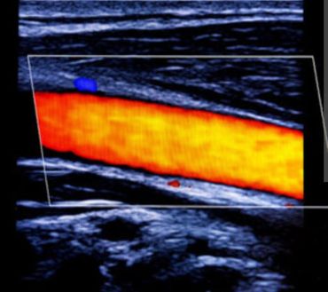 Carotid Artery