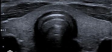 Thyroid Gland