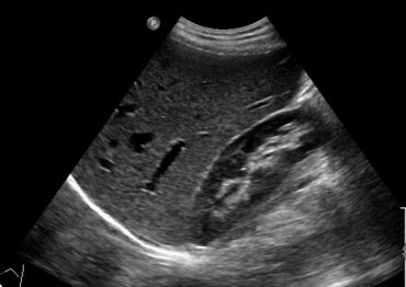Liver/ Right Kidney