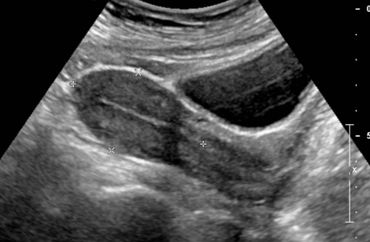 Uterus