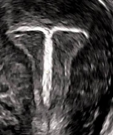 Correct IUD placement