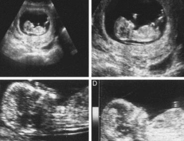 First Trimester