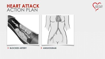 Keynote slide showing illustrations of a blocked artery and angiogram