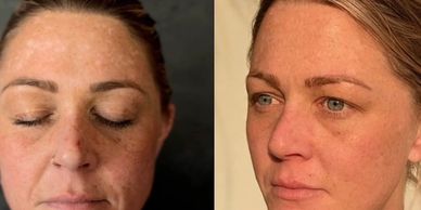 Before and after acne scar camouflage tattoo improving pigment and pitting.