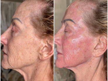 Before & after Tixel  treatment