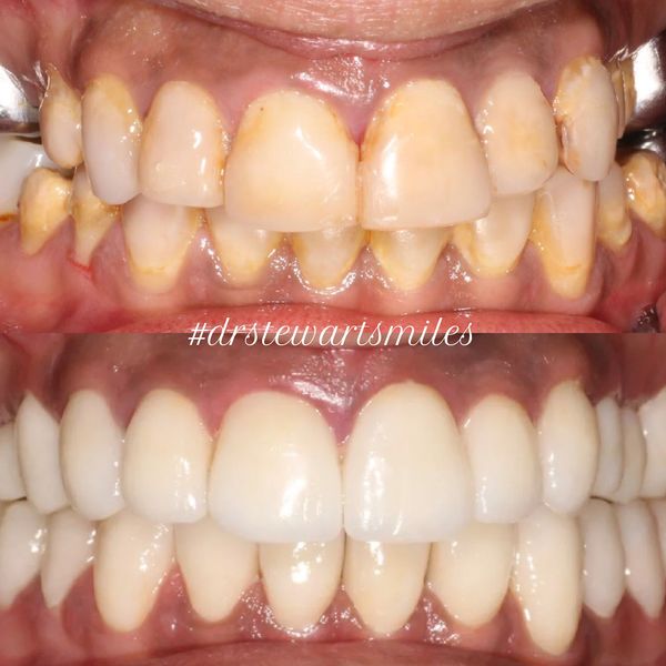 A before and after image of a persons mouth who received crowns top and bottom by Dr Hayden Stewart.