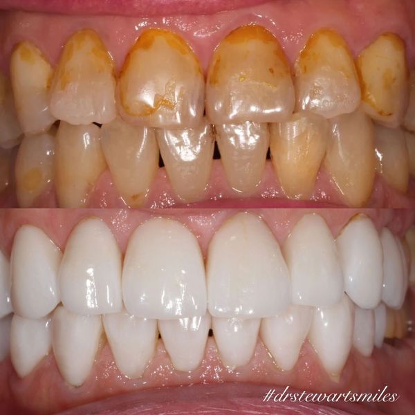 A before and after image of a persons mouth who received Invisalign and then veneers by Dr Hayden St
