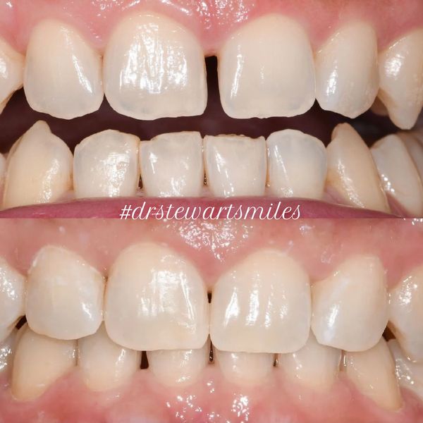A before and after image of a persons mouth who received Invisalign by Dr Hayden Stewart.