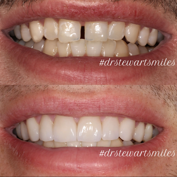 A before and after image of a persons mouth who received veneers by Dr Hayden Stewart.