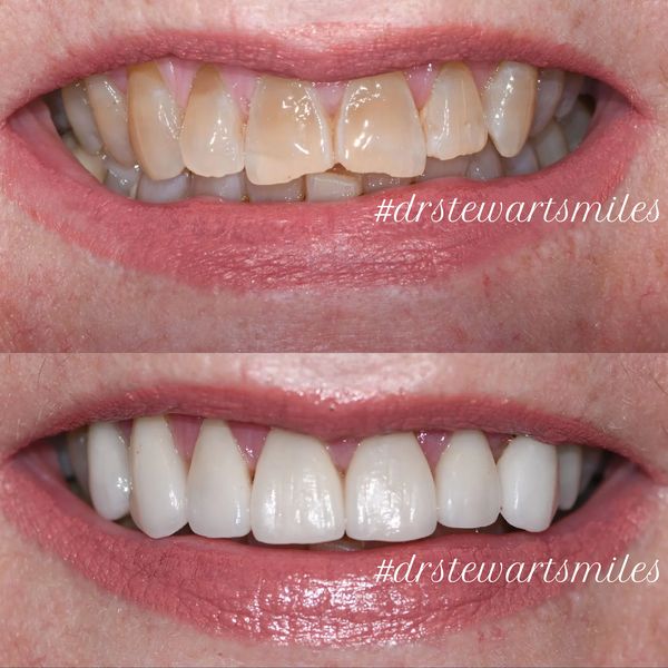A before and after image of a persons mouth who received veneers by Dr Hayden Stewart.