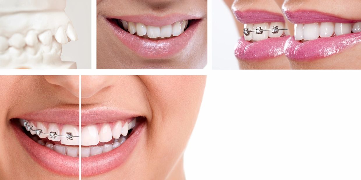 Pictures of metal braces. We offer various options, so head over to the Treatment page to see more.