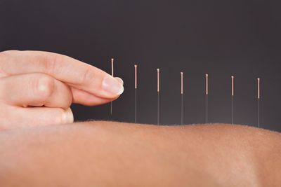 a system of integrative medicine that involves pricking the skin or tissues with needles, used to al