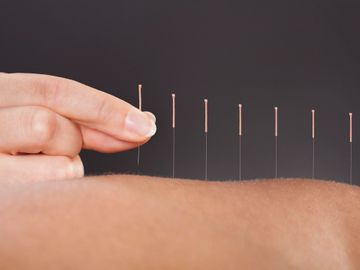Person receiving Acupuncture