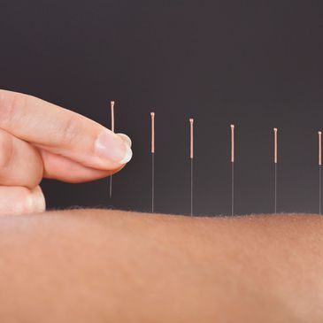 Acupuncture needles being inserted for therapy.