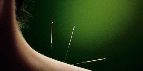 Acupuncture needles in a shoulder muscle