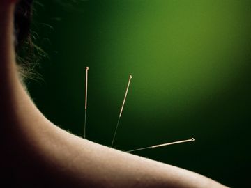 Acupuncture needles on a patients shoulder