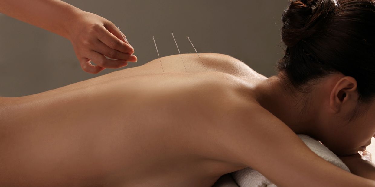Showing person having Acupuncture treatment