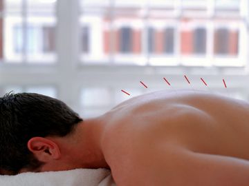 Acupuncture needles inserted along a patient's spine