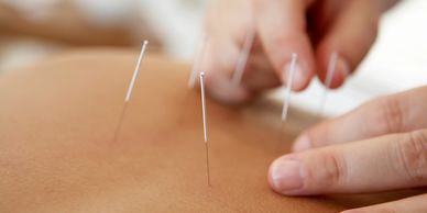 Acupuncture dry needling IMS Ottawa Chiropractor Physiotherapy Physio Chiro massage best in Ottawa