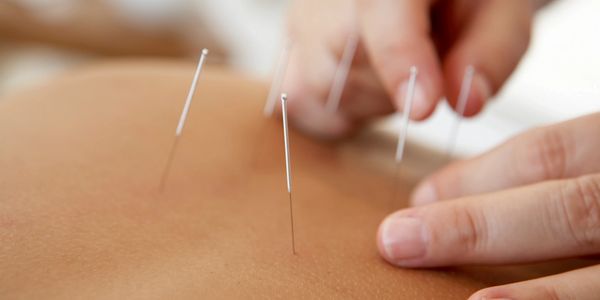 acupuncture needles in situ