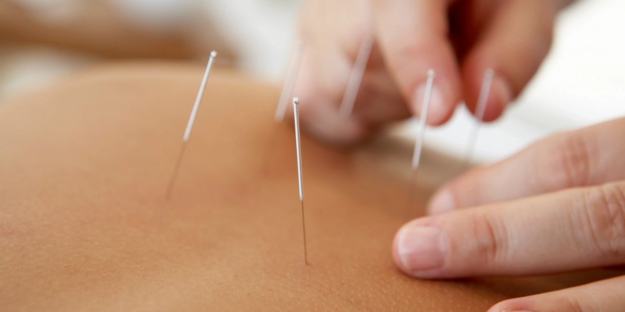 acupuncture ims Ottawa Chiropractic physiotherapy best in Ottawa headaches concussion low back pain