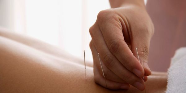 Experience the benefits of acupuncture  with our skilled acupuncturists. #Acupuncture #PainRelief"