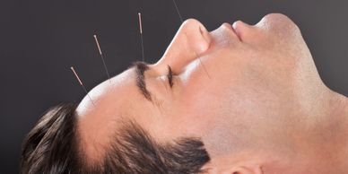 Acupuncture show promise in migraine treatment, study says