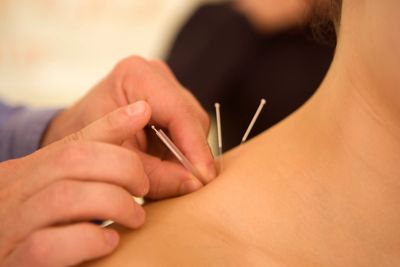 Woman with acupuncture needles on shoulder.