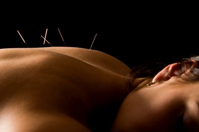A woman laying down with acupuncture needles in her back