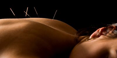Acupuncture for back and neck pain