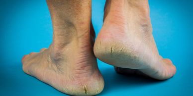 Feet fungus, skin problems in feet. 