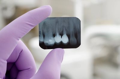 General Dentistry xrays help dentist see exactly what is happening with the tooth and gums.