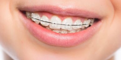 Ortodonti ve tel tedavisi 