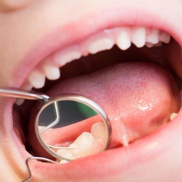 Upclose picture of child's teeth being examined with dental instruments.