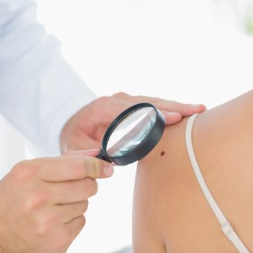 Mole checking and dermatological examination for skin cancer carried out by a Dermatologist