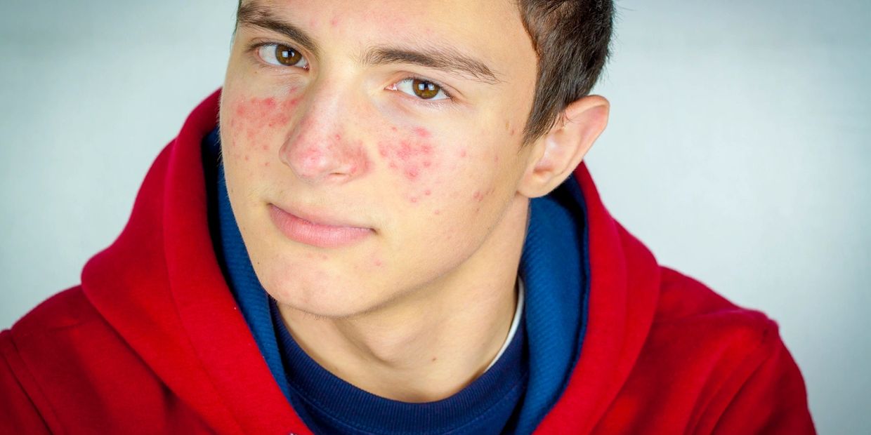 teen boy with acne