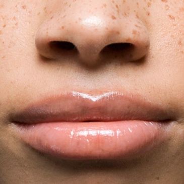 Dermal fillers. Lip fillers that enhance lip line and increase lip volume.
