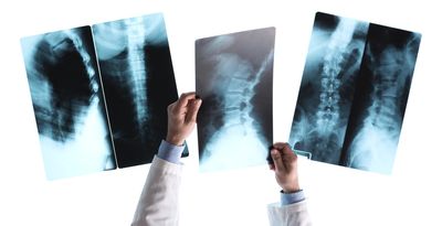 Image of a doctor holding up Xrays at the initial consultation with the chiropractic patient.