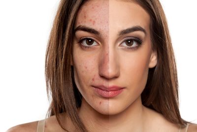 Two halves of a woman’s face, one showing acne and the other clear following treatment 