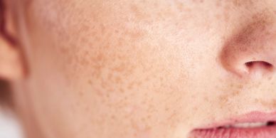 Freckle on face