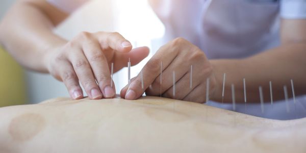 Person receiving acupuncture treatment with needles.