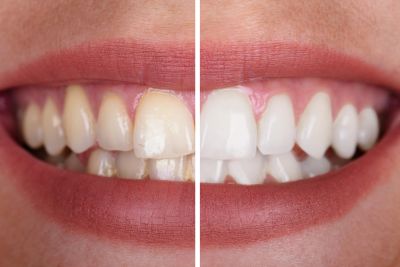 Close-up of teeth showing before and after whitening treatment.