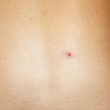 Electrolysis for Cherry Angiomas uses a fine needle and electric current to target the blood vessels