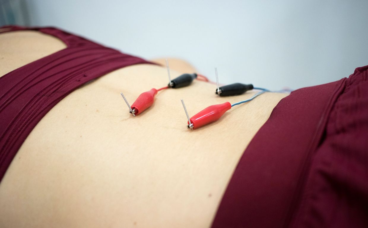 dry needling with electrical stimulation