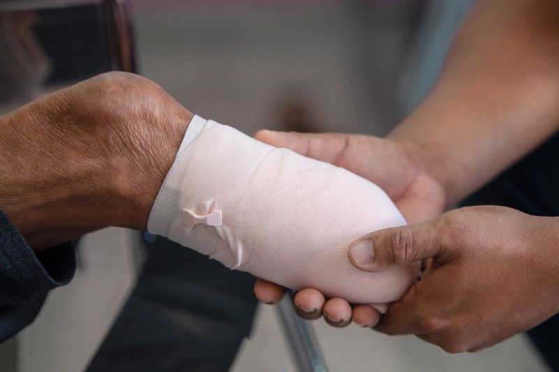 below knee amputation patient with elastic bandaging to prepare for leg prosthesis