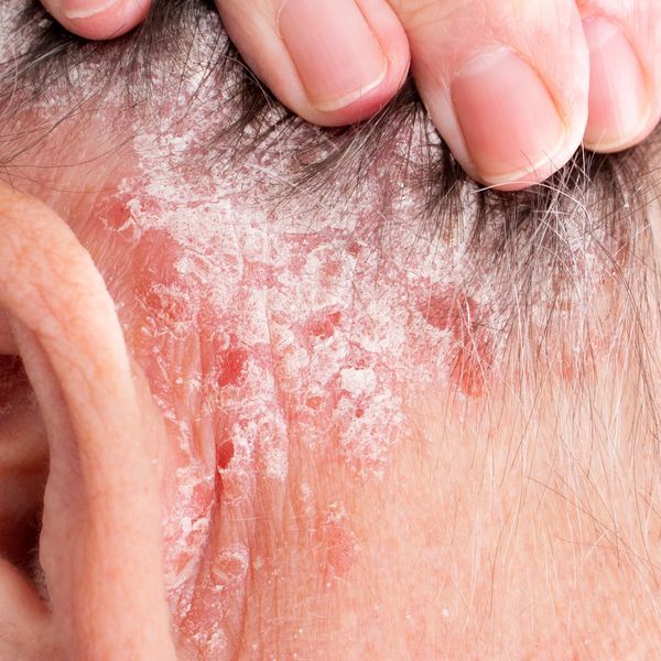 Close-up of flaky, irritated scalp skin.
