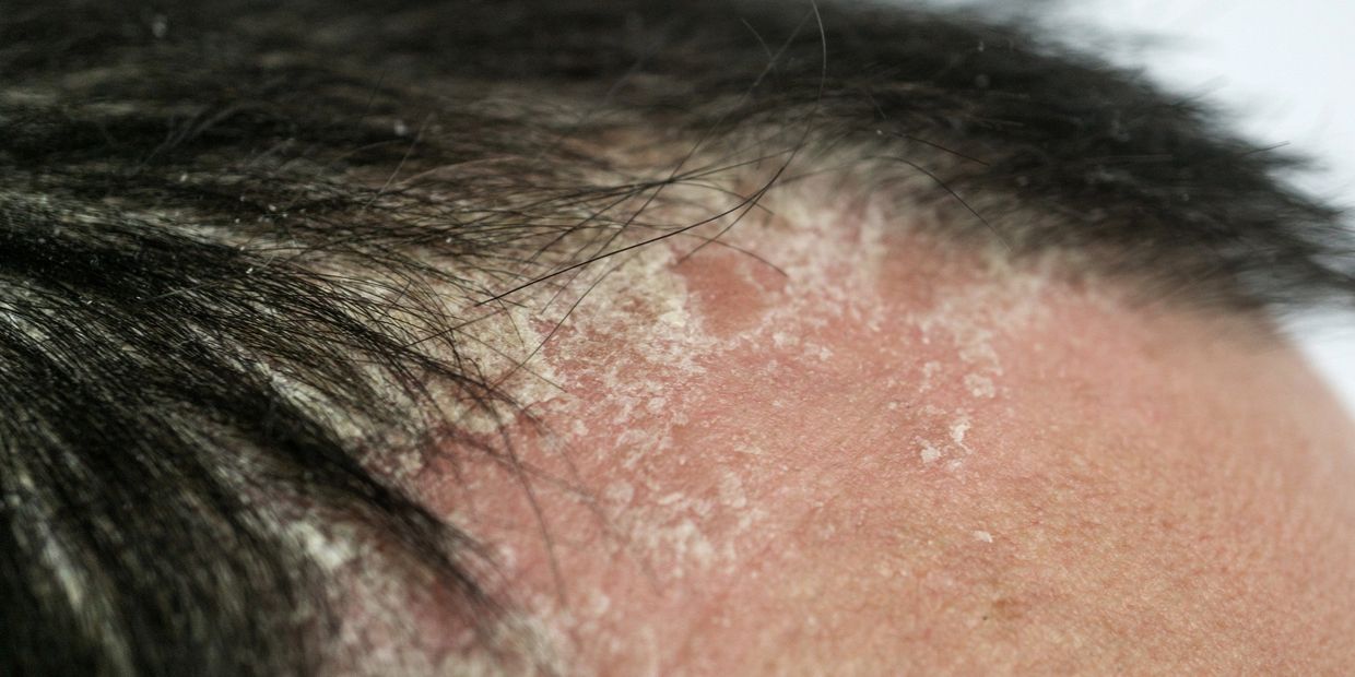 Scalp with dry, flaky skin and irritation.
