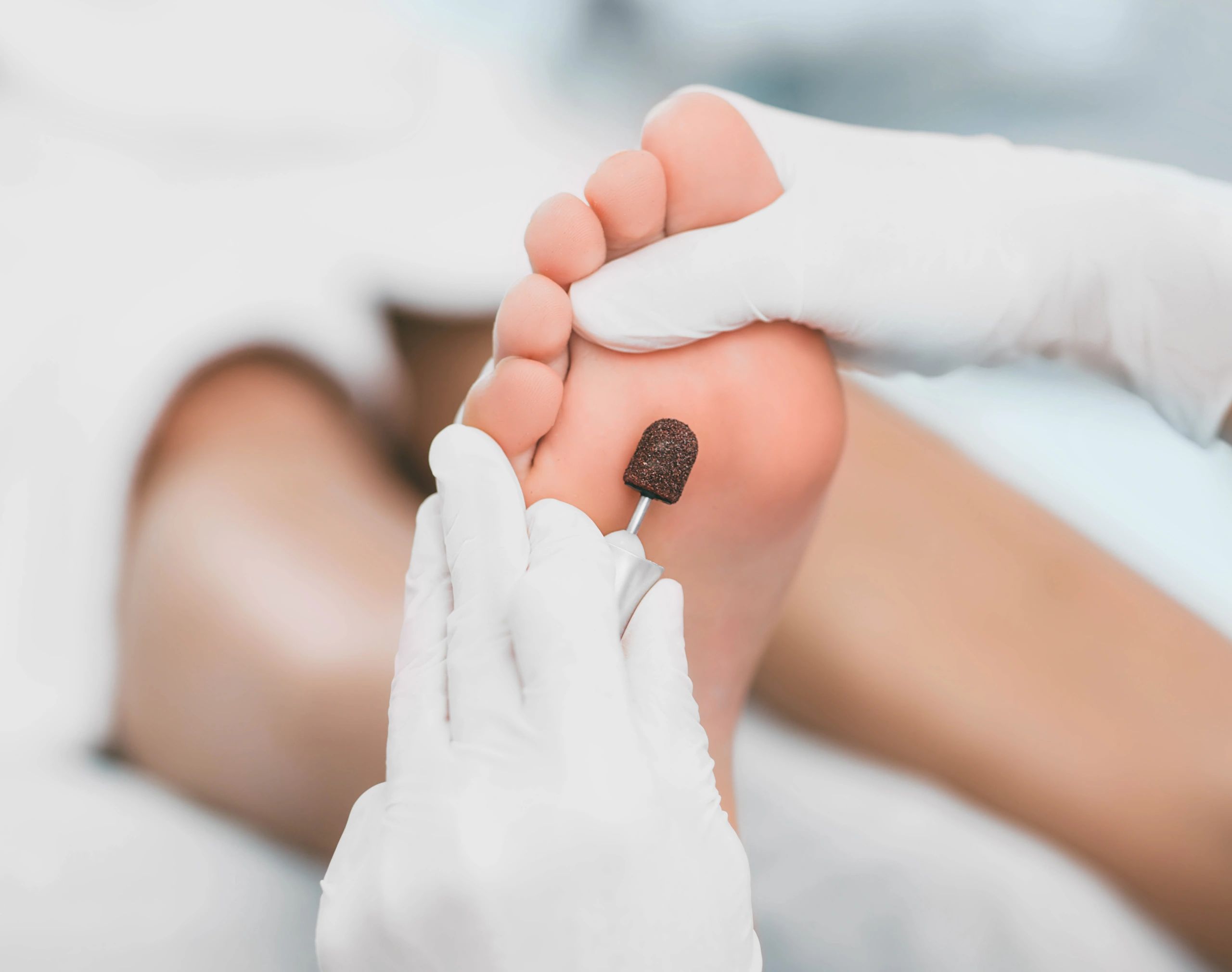 Gloved clinician treating the sole of a patient’s foot with a rotary instrument.