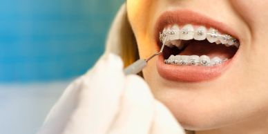 Close-up of dental braces cleaning.